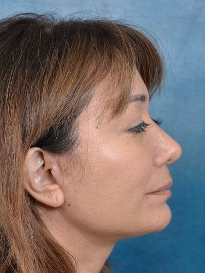 Eyelid Lift Before & After Gallery - Patient 123718986 - Image 6