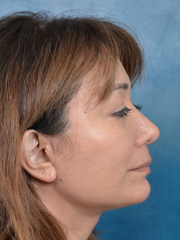 Eyelid Lift Gallery - Patient 123718986 - Image 6
