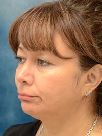Deep Plane Facelift Before & After Gallery - Patient 123718985 - Image 1