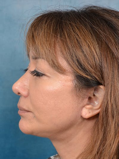 Deep Plane Facelift Before & After Gallery - Patient 123718985 - Image 10