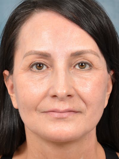 Deep Plane Facelift Before & After Gallery - Patient 123065438 - Image 4