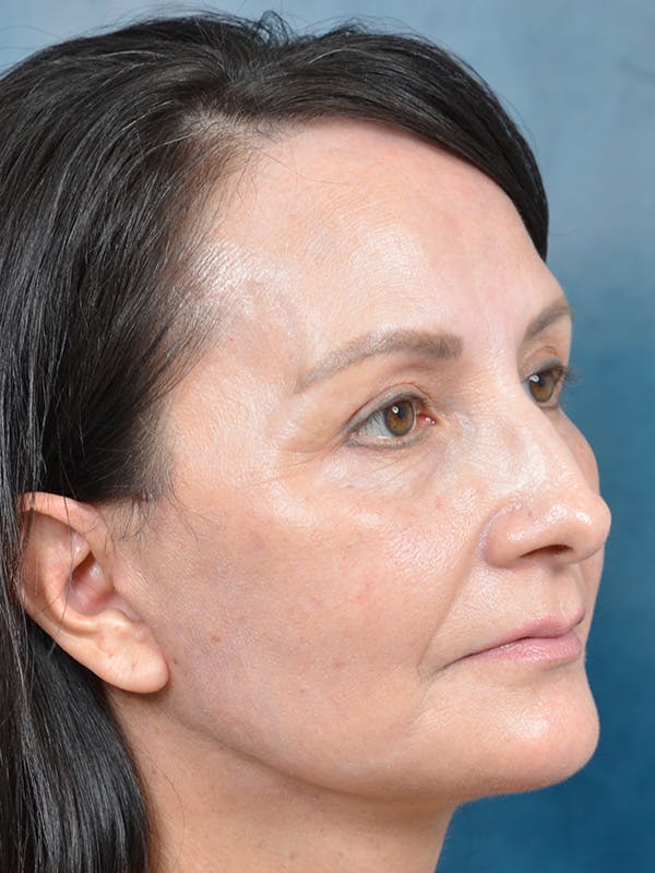 Laser Skin Resurfacing Before & After Gallery - Patient 123065444 - Image 4