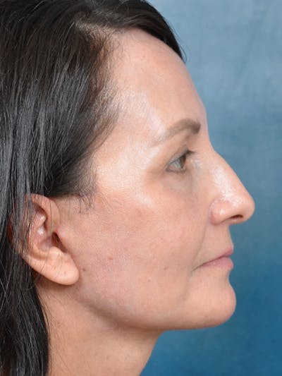 Chin Augmentation Before & After Gallery - Patient 123065439 - Image 6