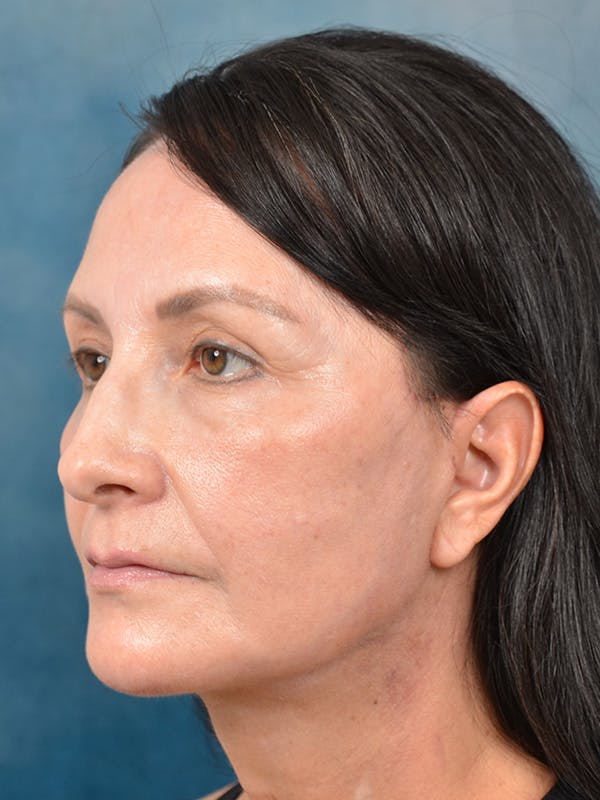 Brow Lift Before & After Gallery - Patient 123065446 - Image 8