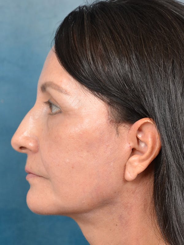 Laser Skin Resurfacing Before & After Gallery - Patient 123065444 - Image 10