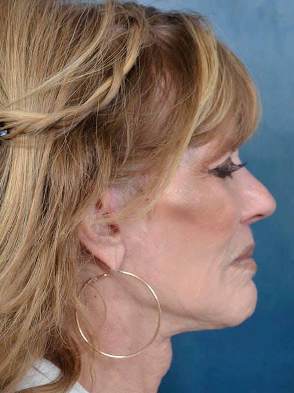 Deep Plane Facelift Before & After Gallery - Patient 123886446 - Image 8