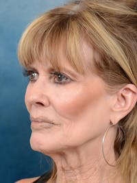Deep Plane Facelift Before & After Gallery - Patient 123886446 - Image 1