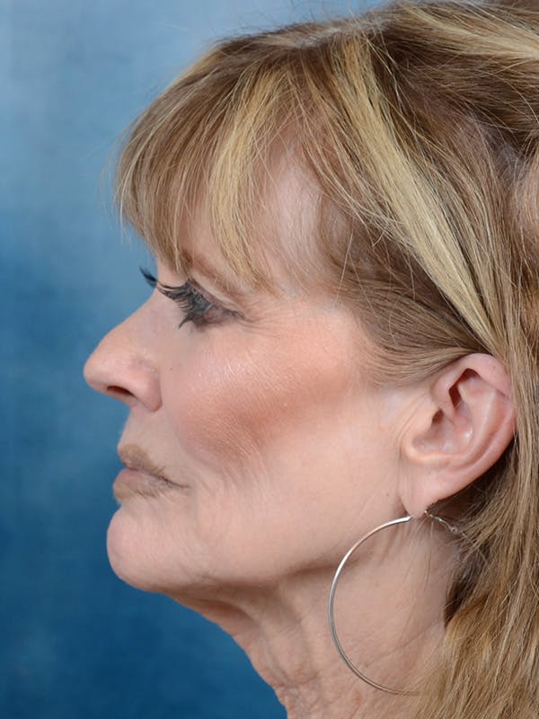 Deep Plane Facelift Before & After Gallery - Patient 123886446 - Image 9