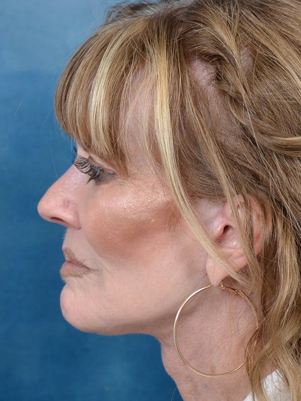 Deep Plane Facelift Before & After Gallery - Patient 123886446 - Image 10