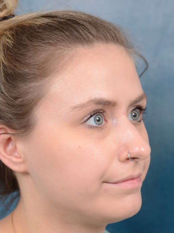 Rhinoplasty Before & After Gallery - Patient 123090626 - Image 5