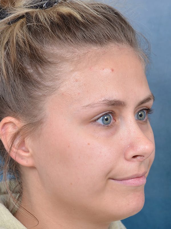 Rhinoplasty Before & After Gallery - Patient 123090626 - Image 6