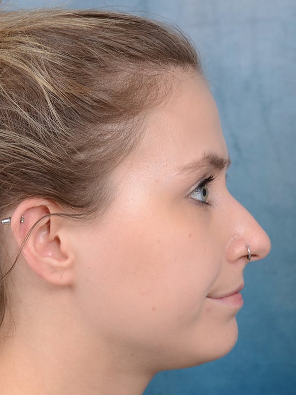 Rhinoplasty Before & After Gallery - Patient 123090626 - Image 7