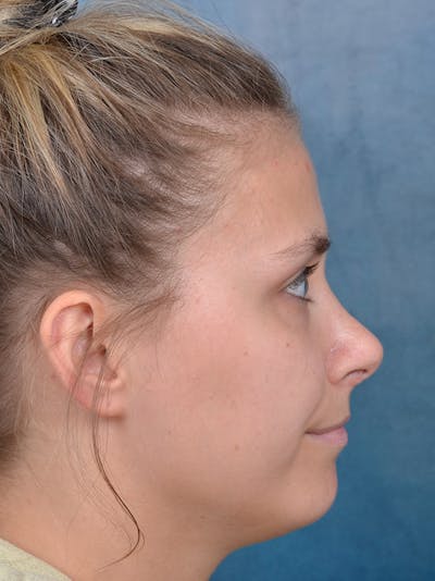 Rhinoplasty Before & After Gallery - Patient 123090626 - Image 8