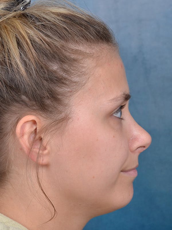 Rhinoplasty Before & After Gallery - Patient 123090626 - Image 8