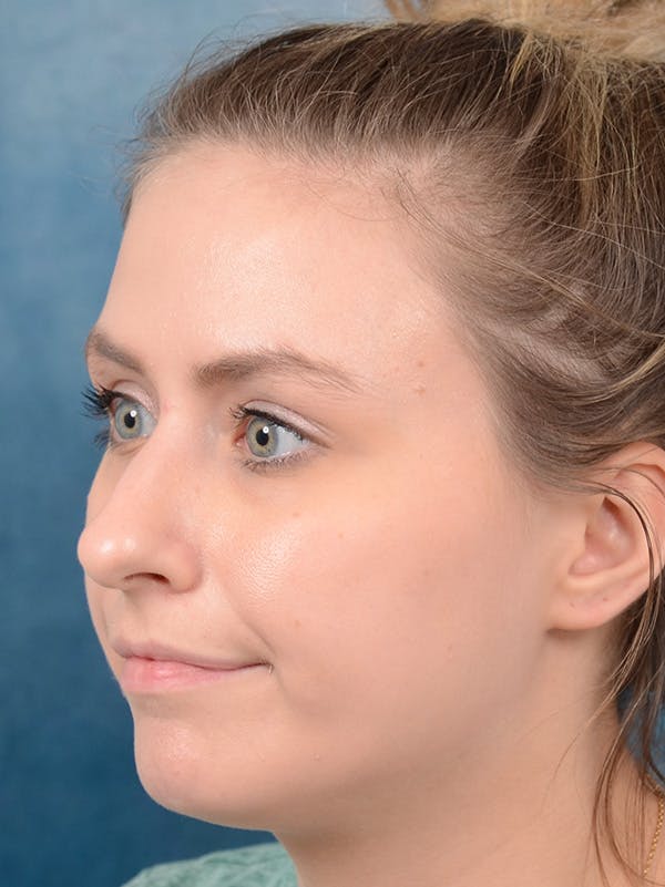 Rhinoplasty Before & After Gallery - Patient 123090626 - Image 9