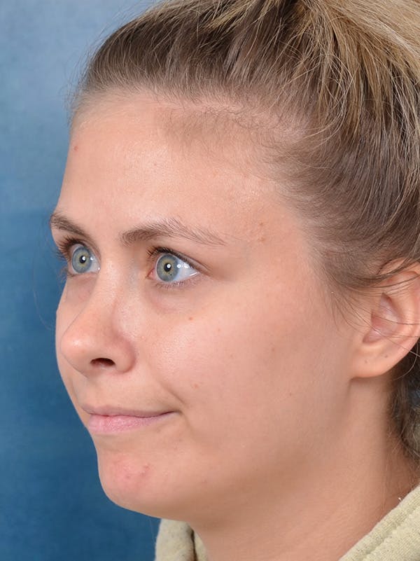 Rhinoplasty Before & After Gallery - Patient 123090626 - Image 10