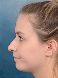 Rhinoplasty Before & After Gallery - Patient 123090626 - Image 1
