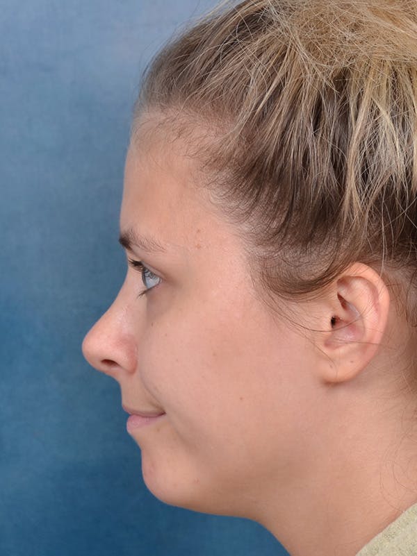 Rhinoplasty Before & After Gallery - Patient 123090626 - Image 2
