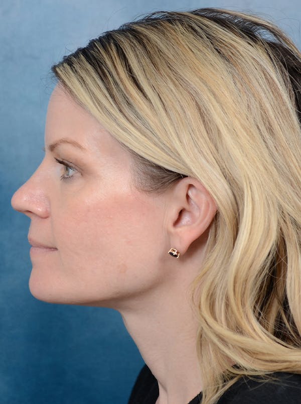 Rhinoplasty Before & After Gallery - Patient 133104525 - Image 1