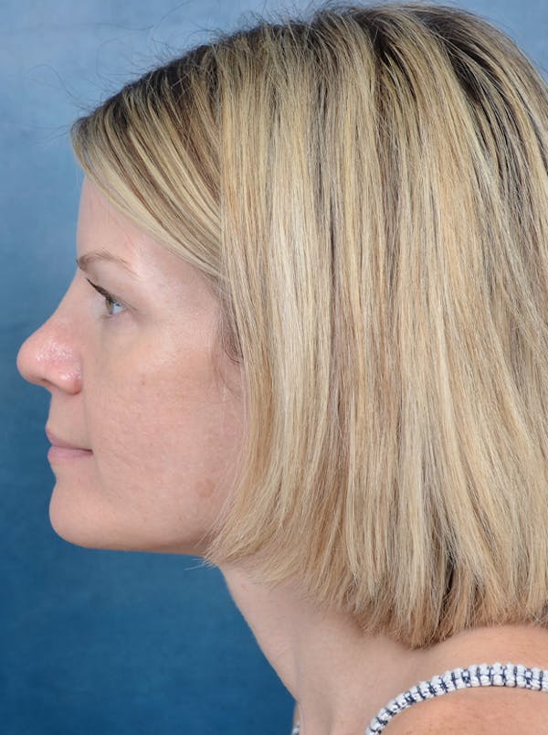 Rhinoplasty Before & After Gallery - Patient 133104525 - Image 2
