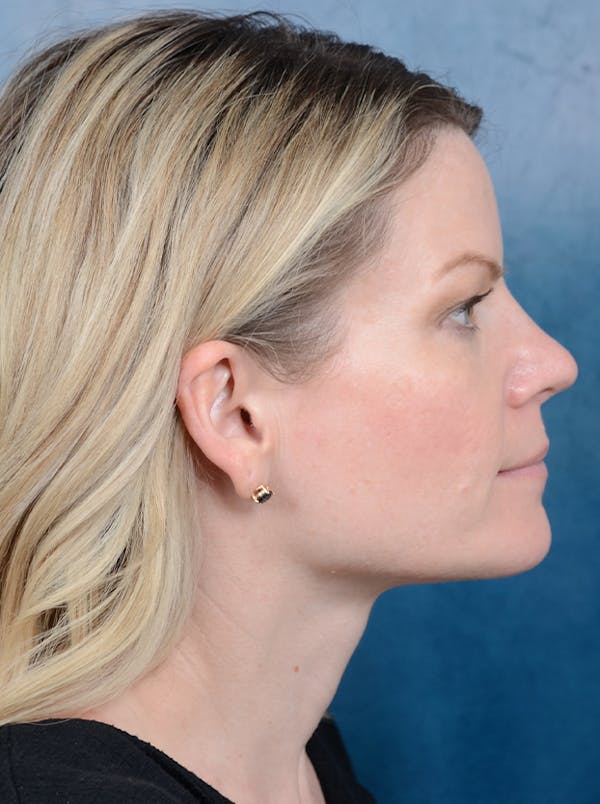 Rhinoplasty Before & After Gallery - Patient 133104525 - Image 7