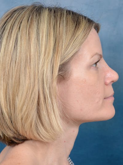 Rhinoplasty Before & After Gallery - Patient 133104525 - Image 8