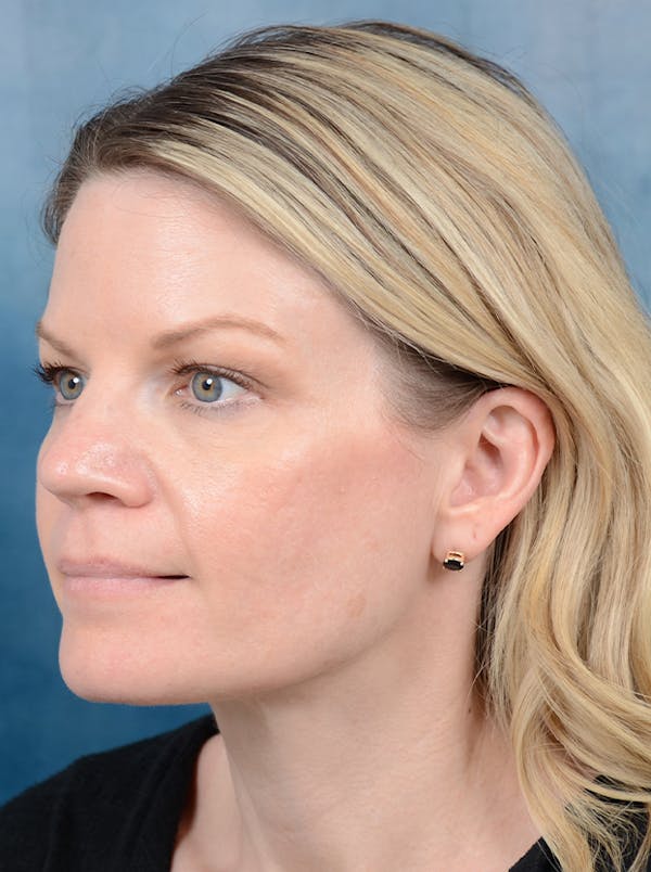 Rhinoplasty Before & After Gallery - Patient 133104525 - Image 9