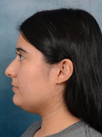 Rhinoplasty Before & After Gallery - Patient 140840468 - Image 1
