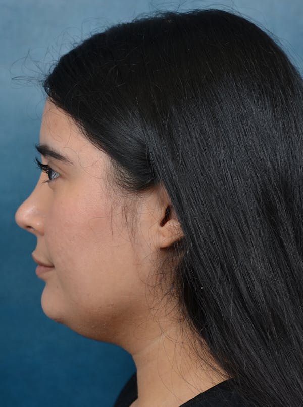 Rhinoplasty Before & After Gallery - Patient 140840468 - Image 2