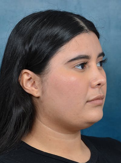 Rhinoplasty Before & After Gallery - Patient 140840468 - Image 6