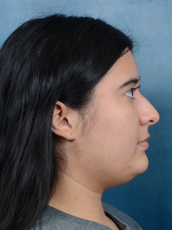 Rhinoplasty Before & After Gallery - Patient 140840468 - Image 7