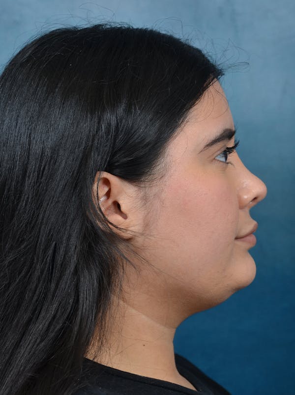 Rhinoplasty Before & After Gallery - Patient 140840468 - Image 8