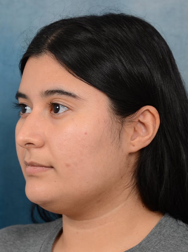 Rhinoplasty Before & After Gallery - Patient 140840468 - Image 9
