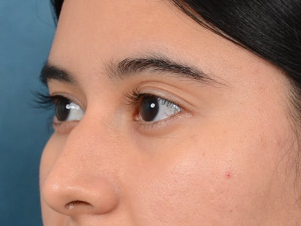 Eyelid Lift Gallery - Patient 133175612 - Image 3