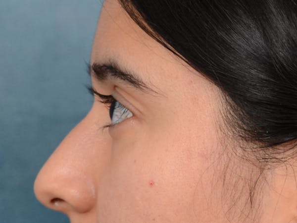 Eyelid Lift Before & After Gallery - Patient 133175612 - Image 5