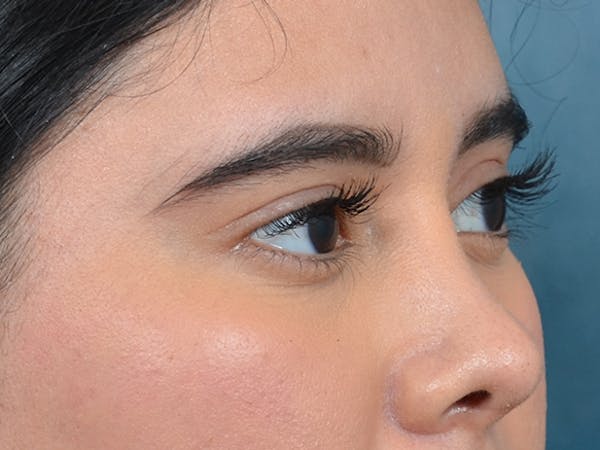 Eyelid Lift Before & After Gallery - Patient 133175612 - Image 9
