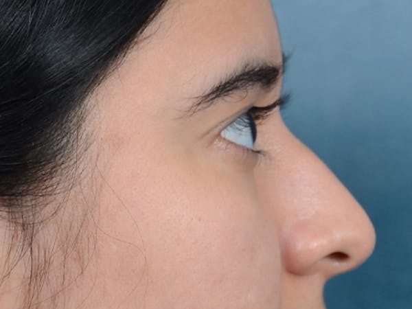 Eyelid Lift Before & After Gallery - Patient 133175612 - Image 7