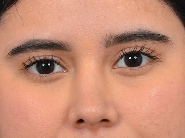 Eyelid Lift Gallery - Patient 133175612 - Image 2