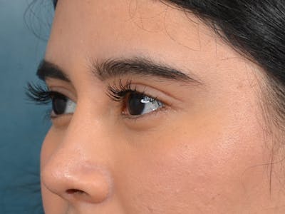 Eyelid Lift Before & After Gallery - Patient 133175612 - Image 4