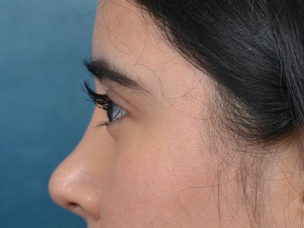 Eyelid Lift Gallery - Patient 133175612 - Image 6