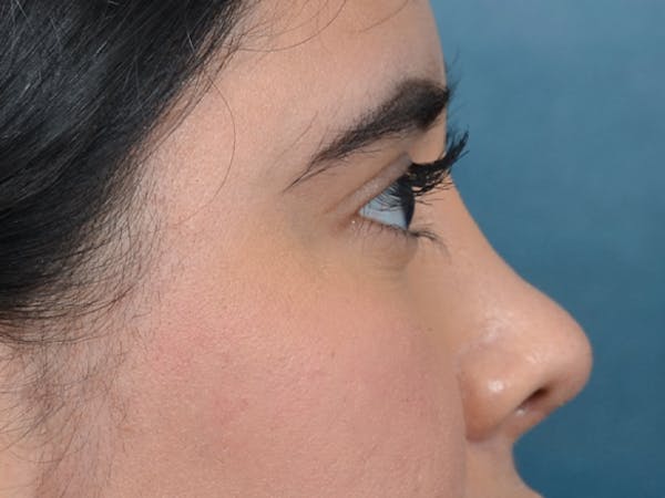 Eyelid Lift Gallery - Patient 133175612 - Image 8