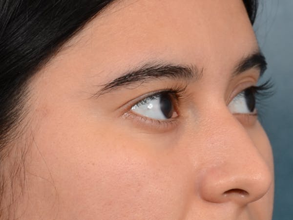 Eyelid Lift Before & After Gallery - Patient 133175612 - Image 10