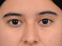 Eyelid Lift Before & After Gallery - Patient 133175612 - Image 1
