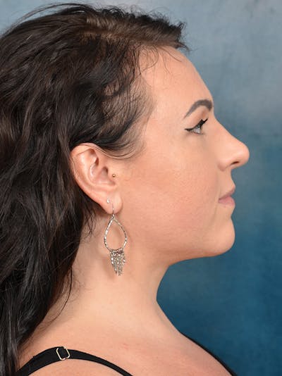 Deep Neck Lift Before & After Gallery - Patient 133186582 - Image 6