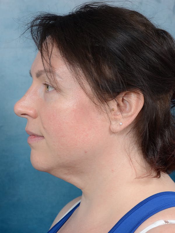 Deep Neck Lift Before & After Gallery - Patient 133186582 - Image 7