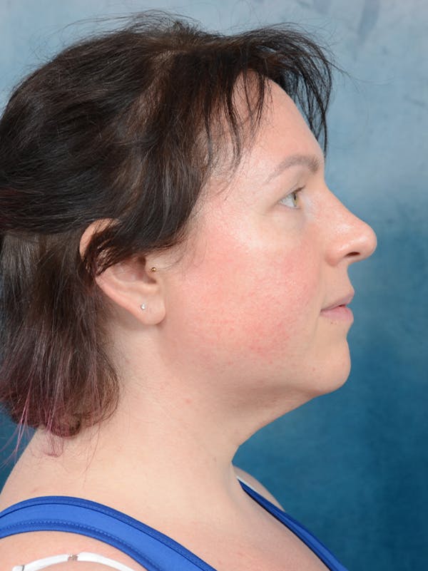 Deep Neck Lift Before & After Gallery - Patient 133186582 - Image 5