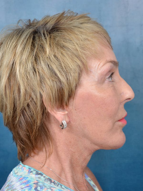 Laser Skin Resurfacing Before & After Gallery - Patient 133258739 - Image 9