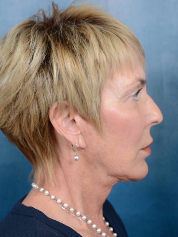 Deep Plane Facelift Before & After Gallery - Patient 141185073 - Image 9