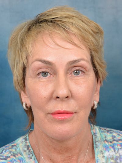 Brow Lift Before & After Gallery - Patient 133259415 - Image 2