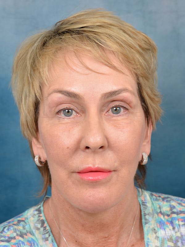Deep Plane Facelift Before & After Gallery - Patient 141185073 - Image 4